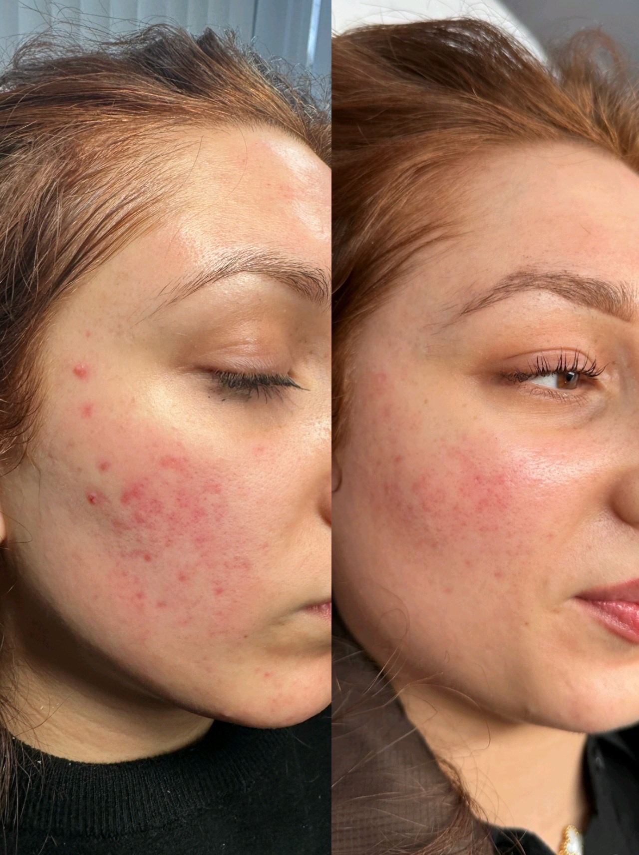 Classic Microneedling