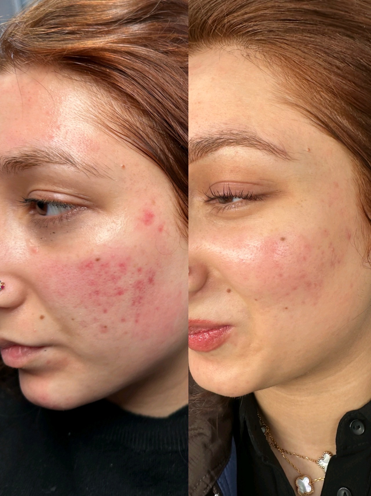 Classic Microneedling