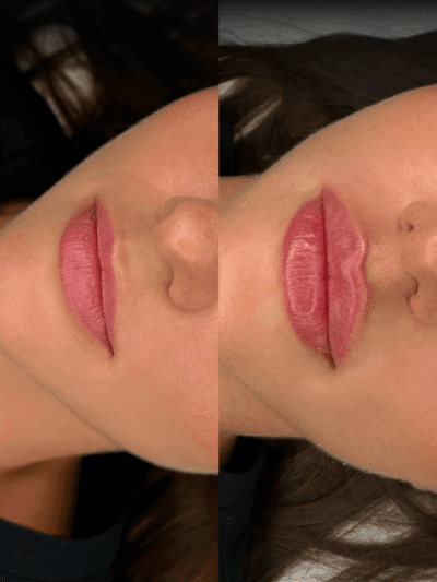 Close-up of lips after dermal filler treatment, showing enhanced volume and definition.