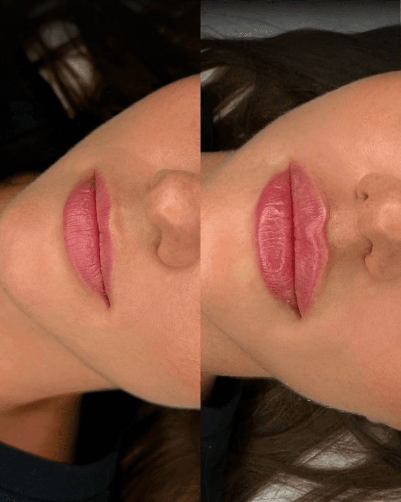 Close-up of lips after dermal filler treatment, showing enhanced volume and definition.