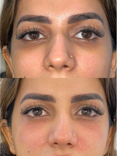 Non-surgical under-eye treatment for dark circles and sunken eyes