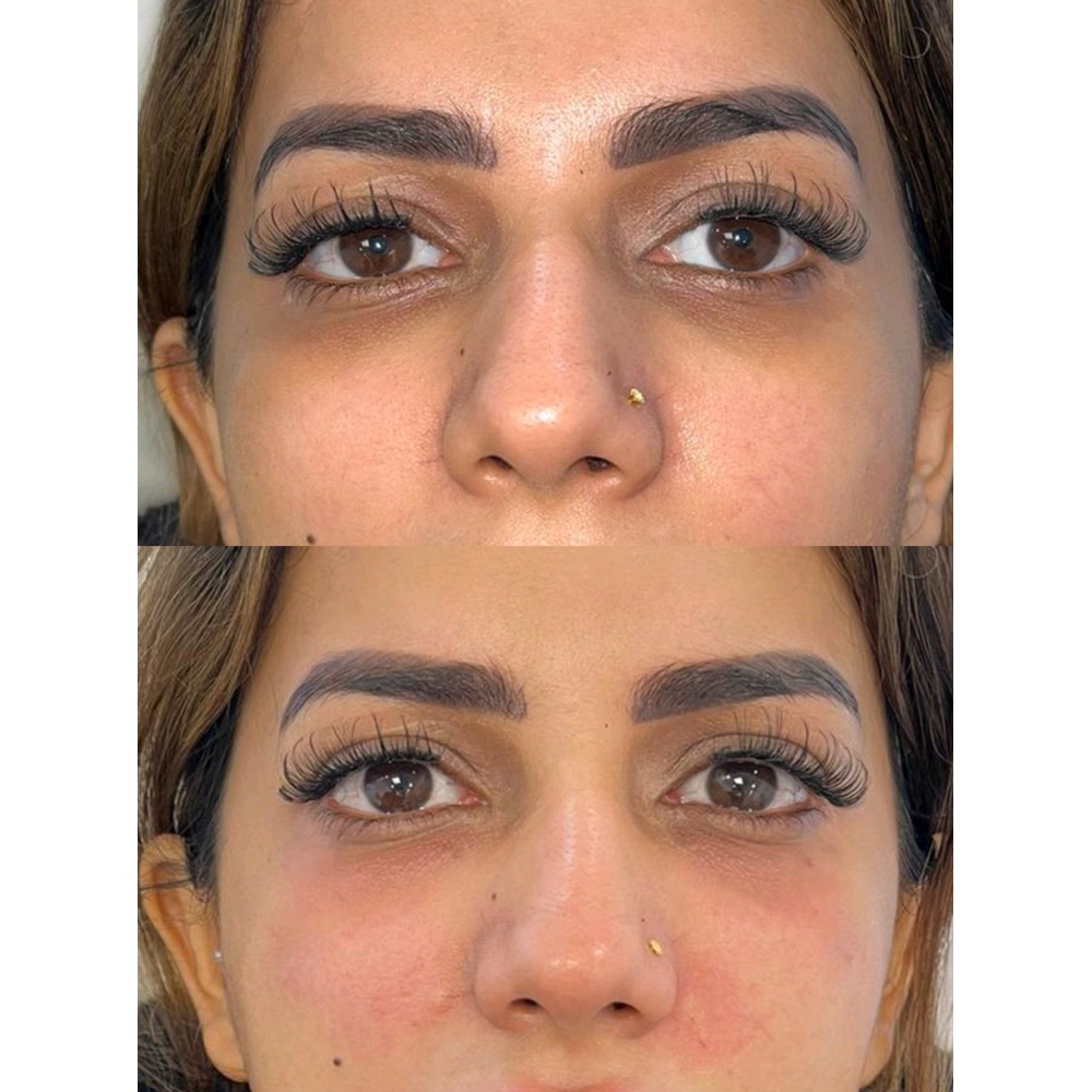Non-surgical under-eye treatment for dark circles and sunken eyes