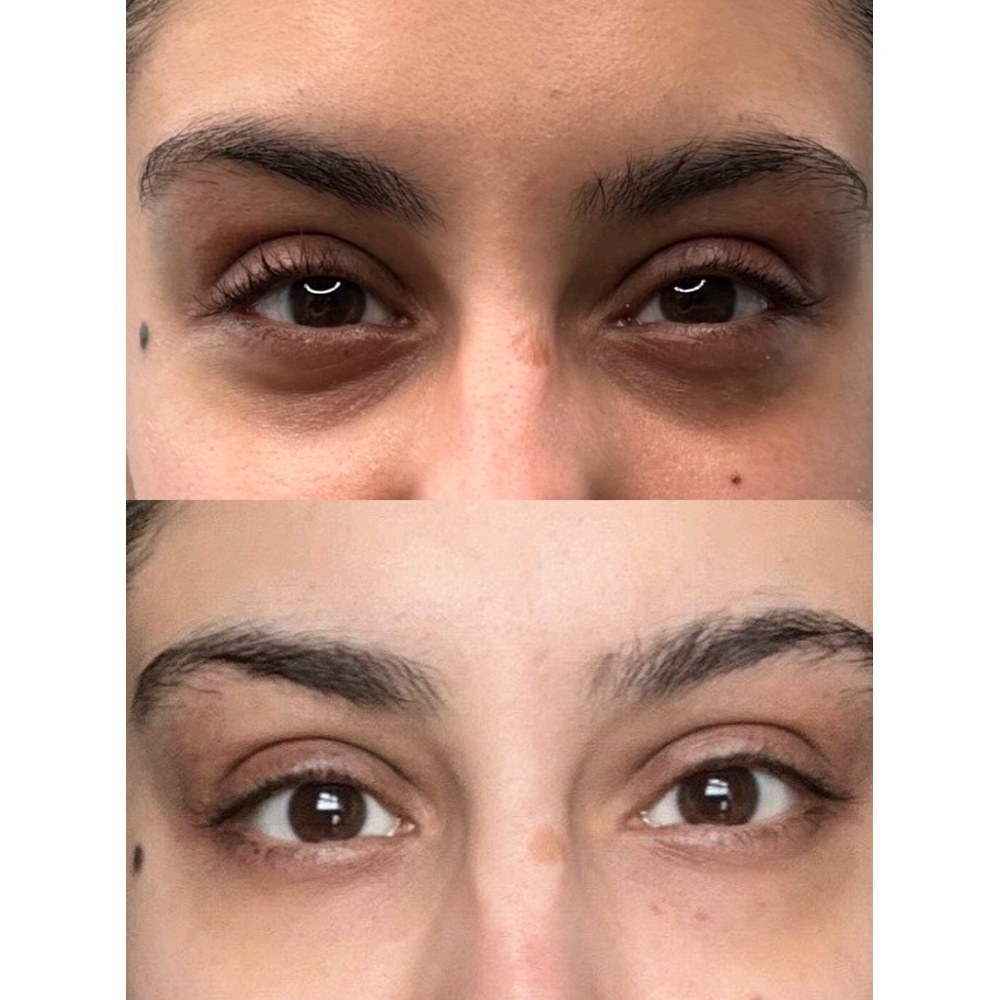 Dark circle correction using skin booster treatment
