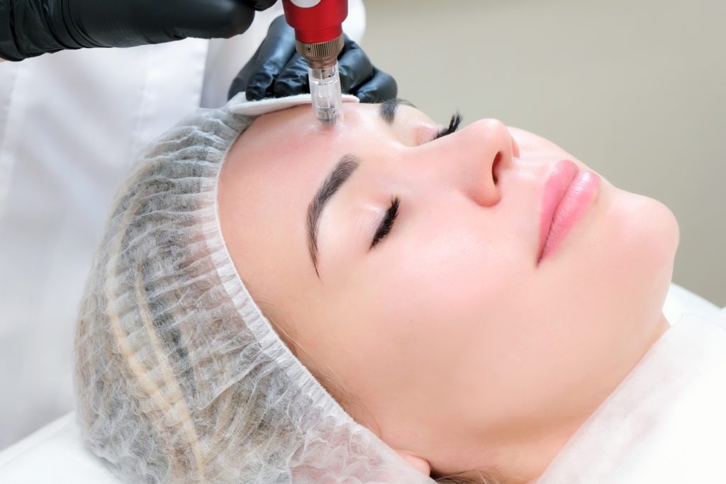 Microneedling