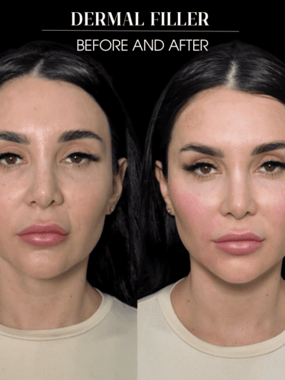 Facial dermal fillers used to restore volume and improve contour