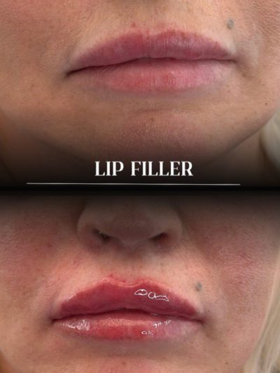 lip filler