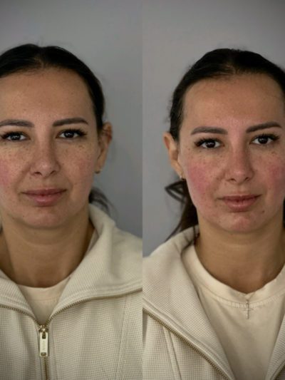 profhilo skin booster